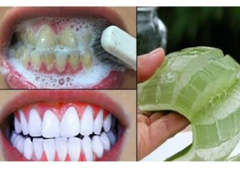 Гэрийн нөхцөлд шүдний чулуу арилгах арга