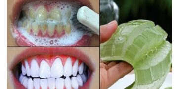 Гэрийн нөхцөлд шүдний чулуу арилгах арга