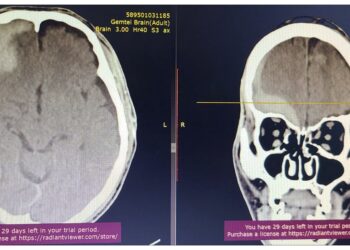 Гавал тархины гэмтлийн дурангийн мэс заслыг амжилттай нэвтрүүллээ