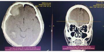 Гавал тархины гэмтлийн дурангийн мэс заслыг амжилттай нэвтрүүллээ