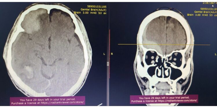 Гавал тархины гэмтлийн дурангийн мэс заслыг амжилттай нэвтрүүллээ