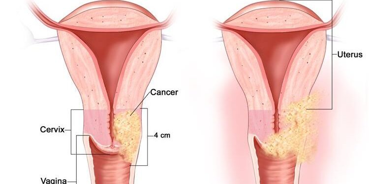 С. Мөнхбат: Умайн хүзүүний хавдраар өвчилсөн тохиолдолд хүүхэд төрүүлэх асуудал дэндүү оройтсон байдаг