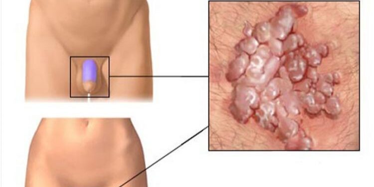 Бэлгийн үү буюу Хүний папиломавирусын халдвар гэж юу вэ?