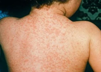 Нийслэлд менингококкцемийн халдвар бүртгэгдлээ