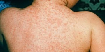 Нийслэлд менингококкцемийн халдвар бүртгэгдлээ