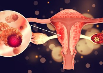 ДЭМБ: Дорвитой арга хэмжээ авахгүй бол 2050 он гэхэд Монголд умайн хүзүүний хавдар 77.6% нэмэгдэнэ!