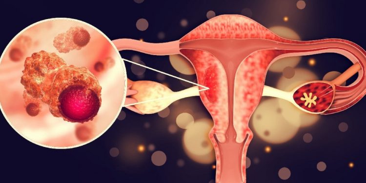 ДЭМБ: Дорвитой арга хэмжээ авахгүй бол 2050 он гэхэд Монголд умайн хүзүүний хавдар 77.6% нэмэгдэнэ!