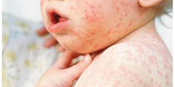 Улаанбурханаар өвдсөн хоёр хүүхэд нас баржээ