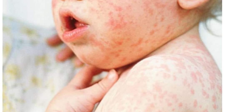 Улаанбурханаар өвдсөн хоёр хүүхэд нас баржээ