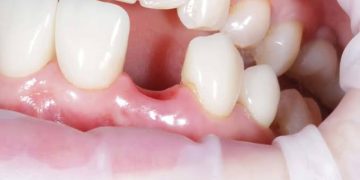 Шинэ шүд ургуулах эмчилгээг 2030 оноос нэвтрүүлнэ