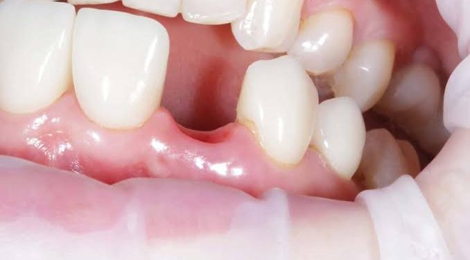 Шинэ шүд ургуулах эмчилгээг 2030 оноос нэвтрүүлнэ